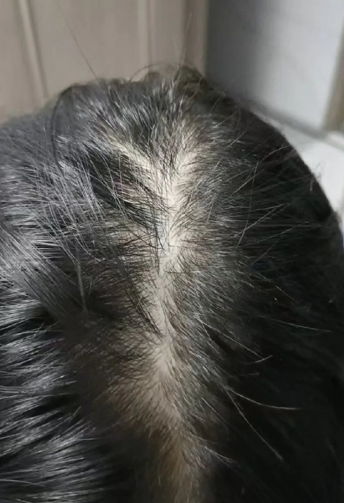 如果脱发是因为节食或营养不良,可以多吃瘦肉,鸡蛋,牛奶,还有蔬菜