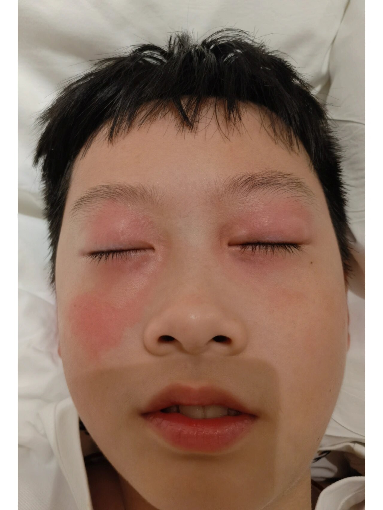 儿子老是眼睛上长疙瘩,还痒,像是过敏的症状,但为什么老是过敏在眼睛