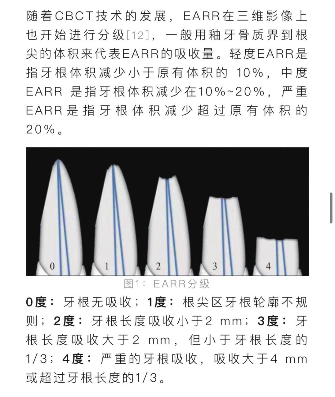 正畸必看之-牙根吸收 牙根吸收 分类:牙根外吸收和牙根内吸收,而正畸