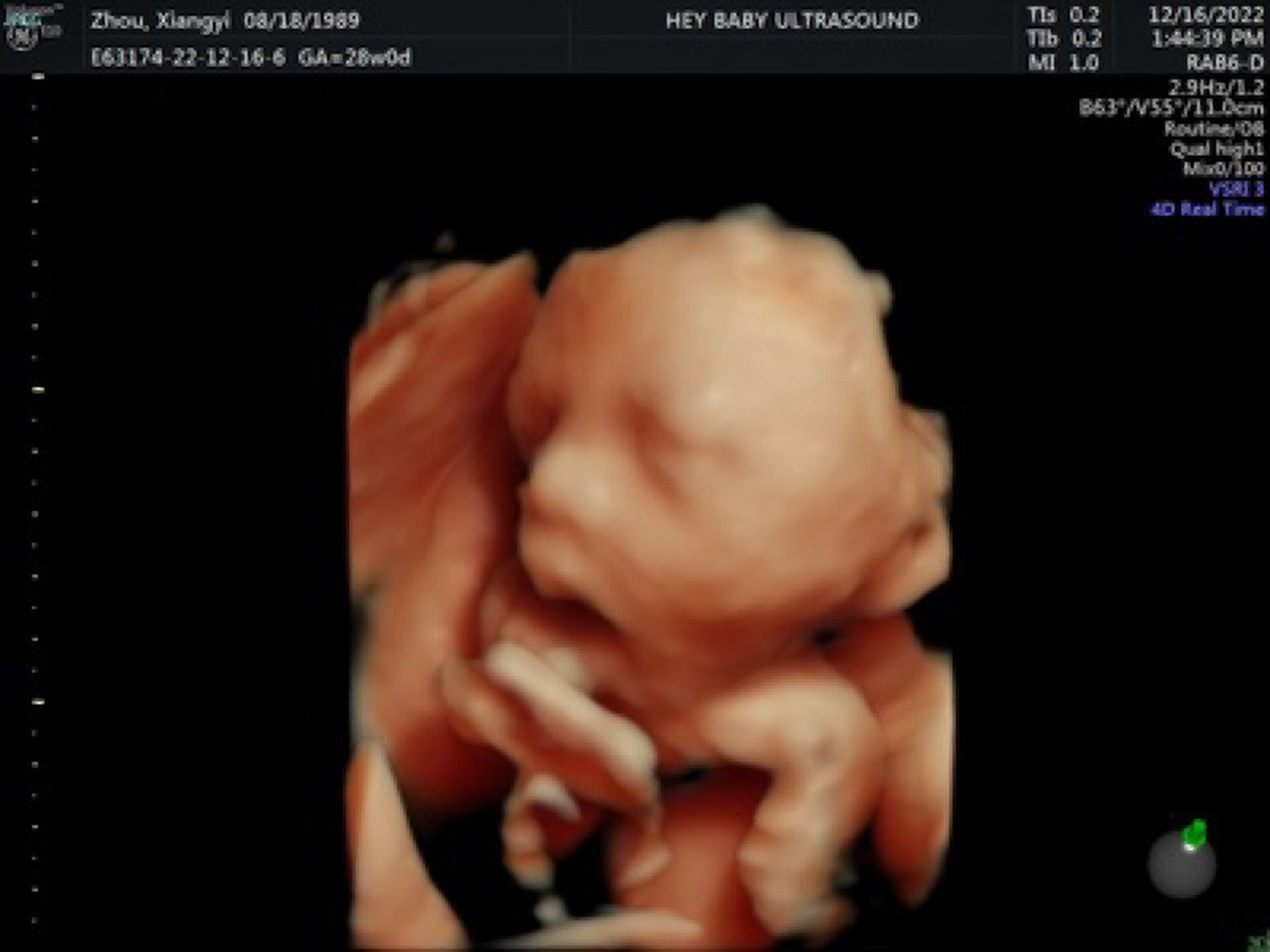 28周了,今天照了四维彩超,宝宝鼻子好大啊 其实我的大排畸一个多月之