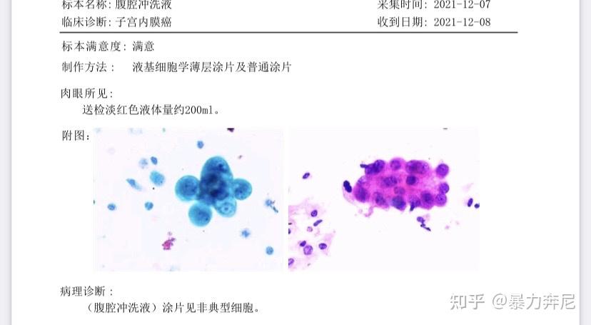 子宫内膜癌免疫组化解读