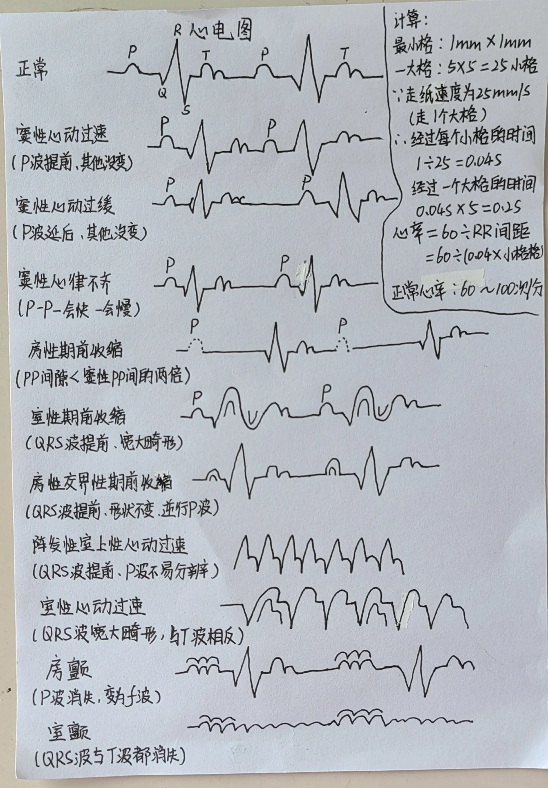 心脏早搏心电图怎么看图片