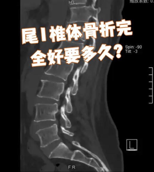 尾1椎体骨折完全恢复通常需要三个月左右