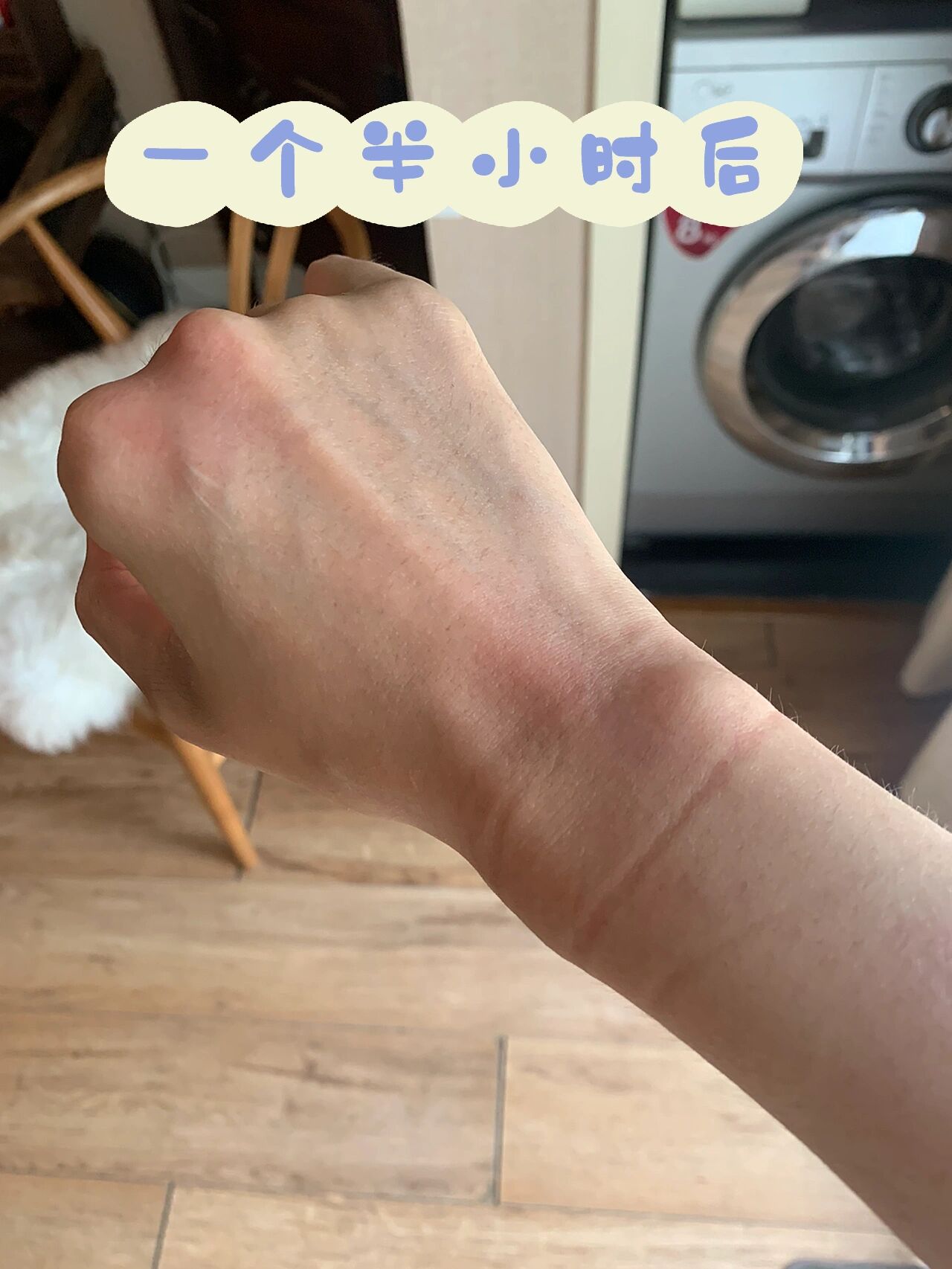 被洋辣子蛰了,能抢救下吗 今天又惨烈了,今年夏天第一次被蜇,每年总会