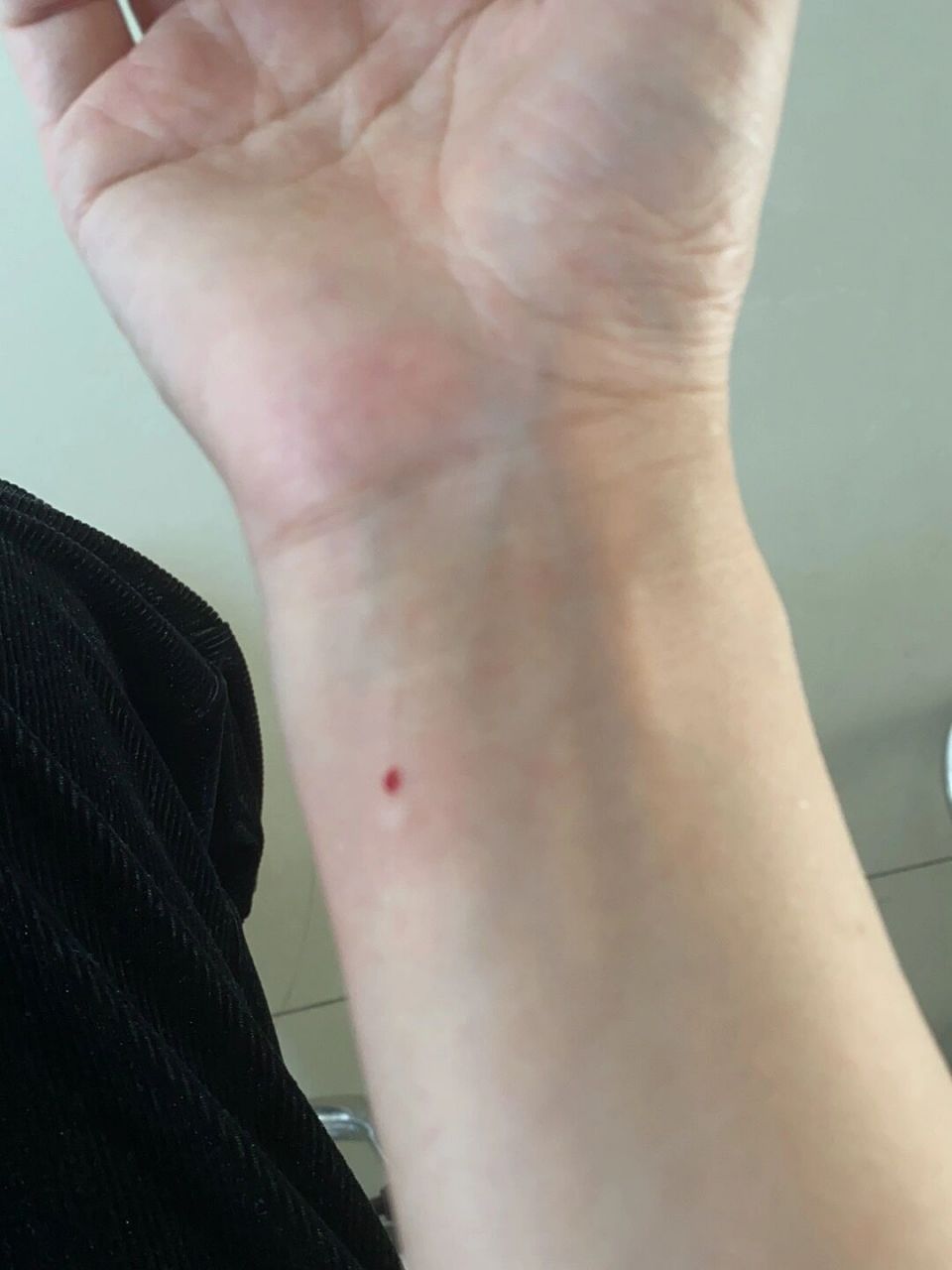 去打一针破伤风免疫球蛋白要400块