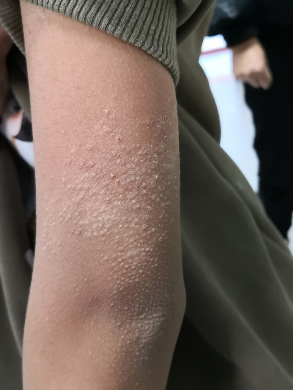 四肢干燥角化过度脱屑丘疹.要排查一下#特应性皮炎# 诊断