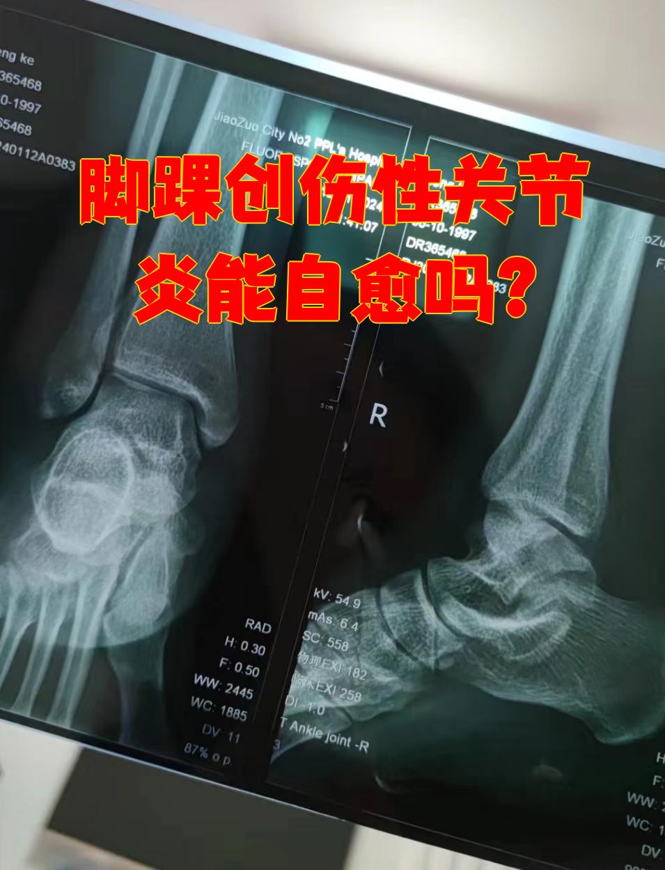 脚踝创伤性关节炎通常无法自愈,必须通过治疗才能改善病情