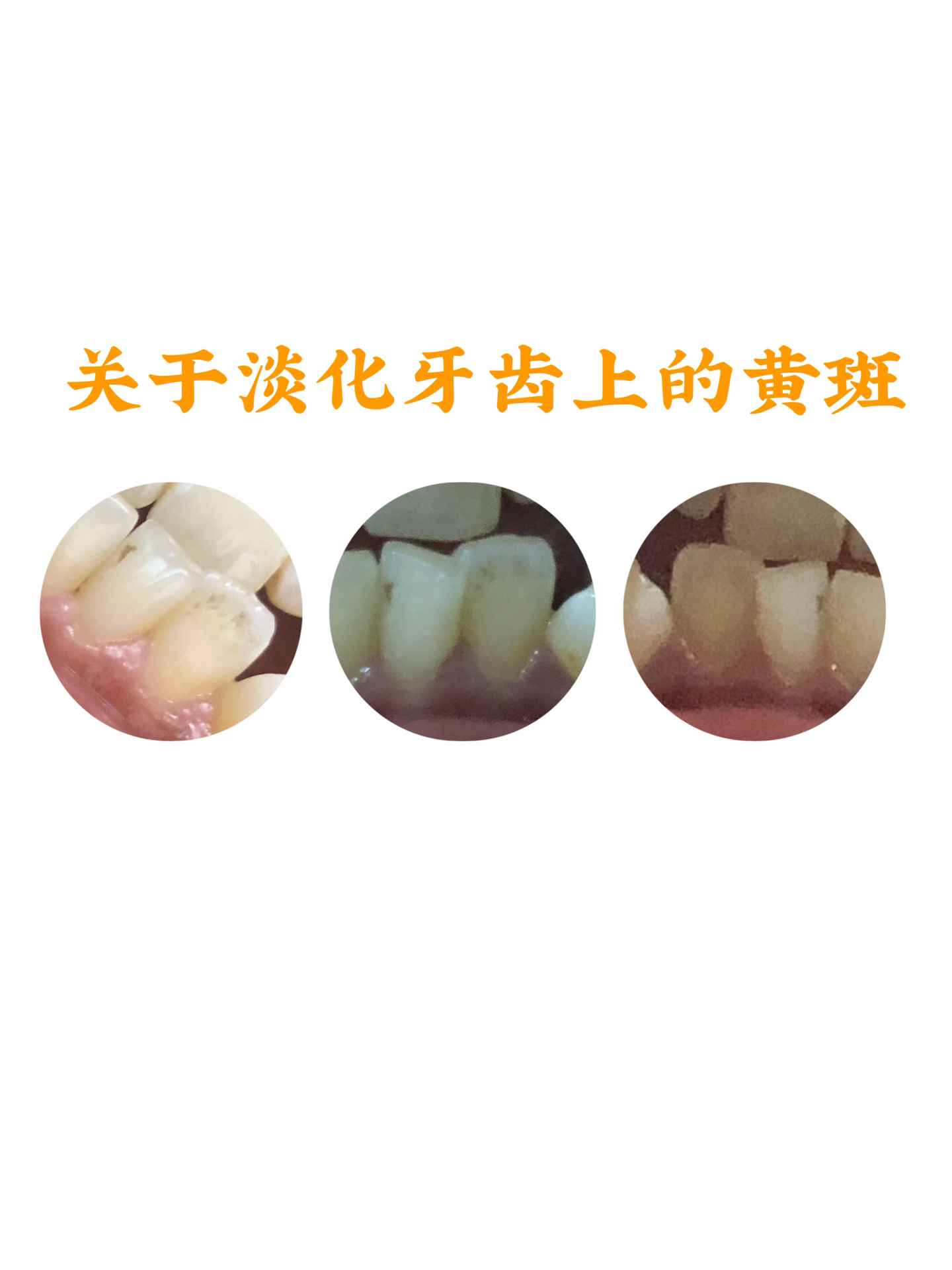 关于淡化牙齿上黄黑斑这个事(纯分享) 去年11月份左右,我突然发现我