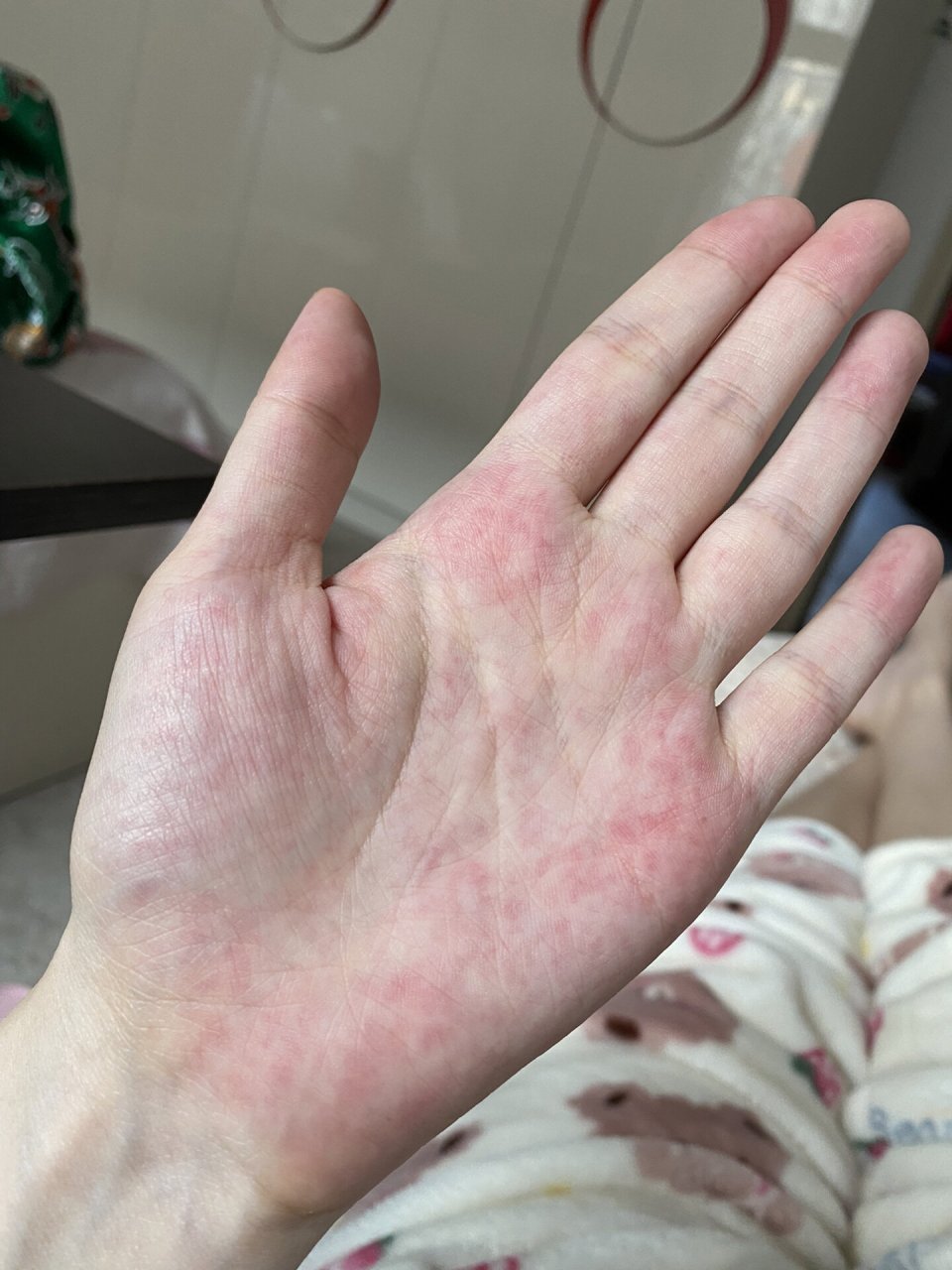 大家怀孕有手掌变这样的吗 孕33w➕5 昨天偶然发现手心都是红色印子