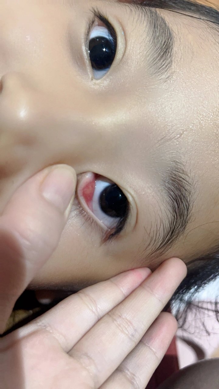 霰粒肿消除之路1 那是一个周末的早晨,起床,发现娃的眼睛9915有点