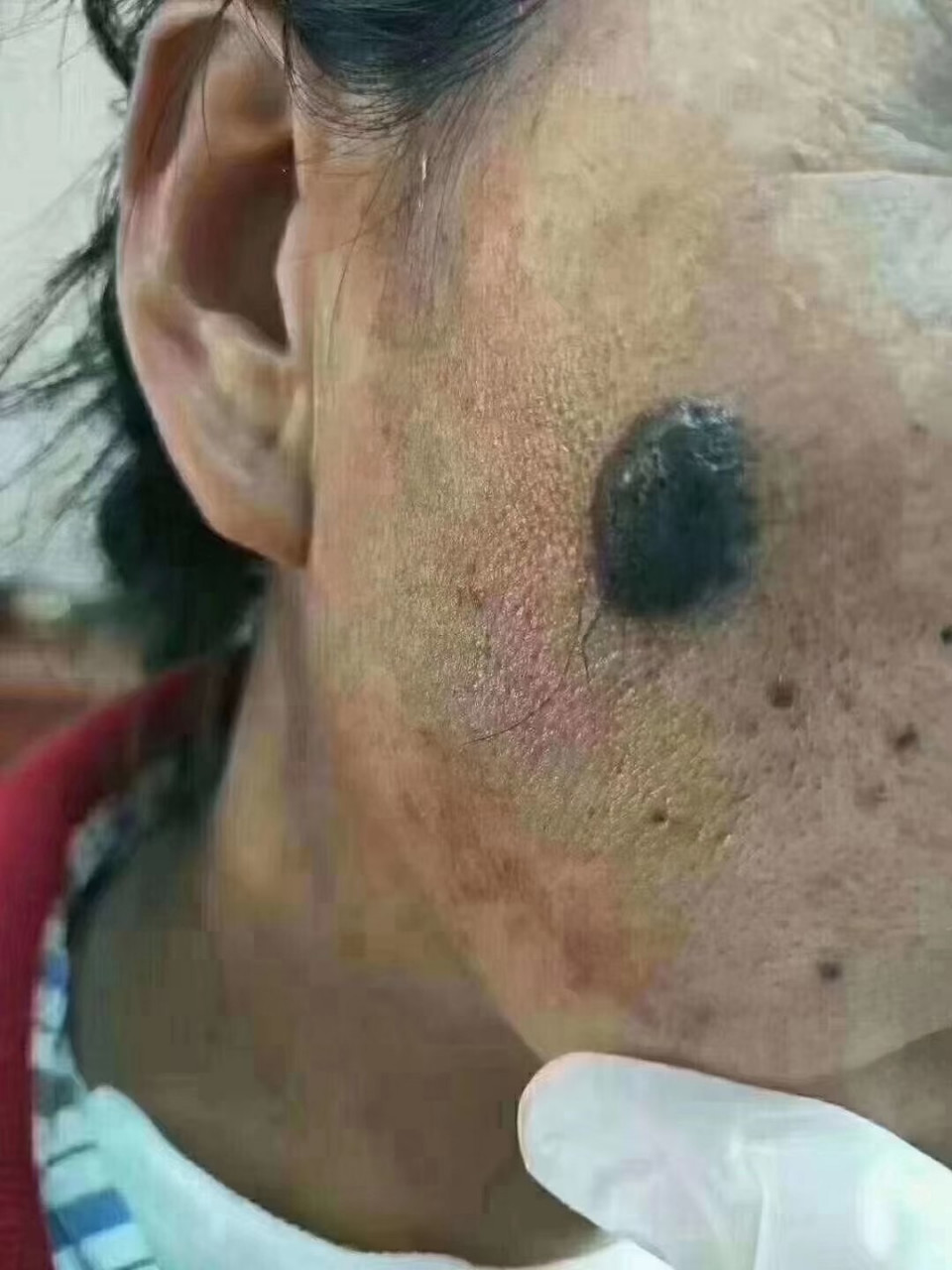 身上有痣突然变大就要重视  痣的癌变信号 短期内突然变大 颜色加深