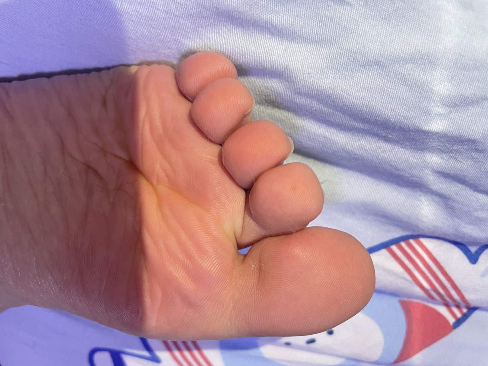 脚底痣 图一二是左脚 图三是右脚 可以一次嘎掉吗?