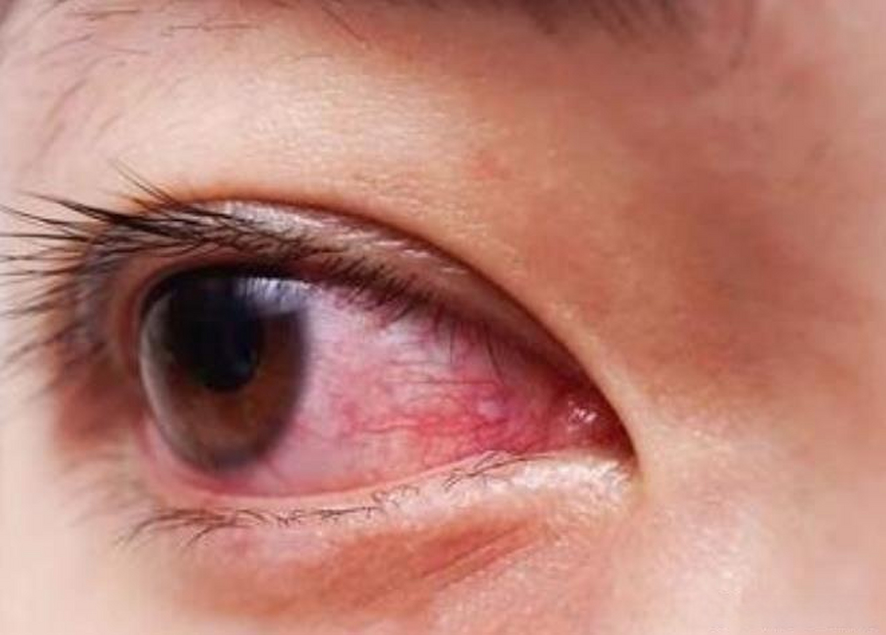 眼健康光明计划# 很多过敏性结膜炎患者,每年一到季节就会出现眼睛痒