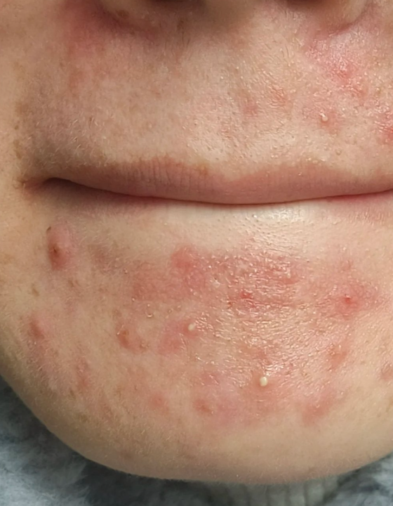 下巴长痘痘红肿硬硬的,这种情况属于中度痤疮