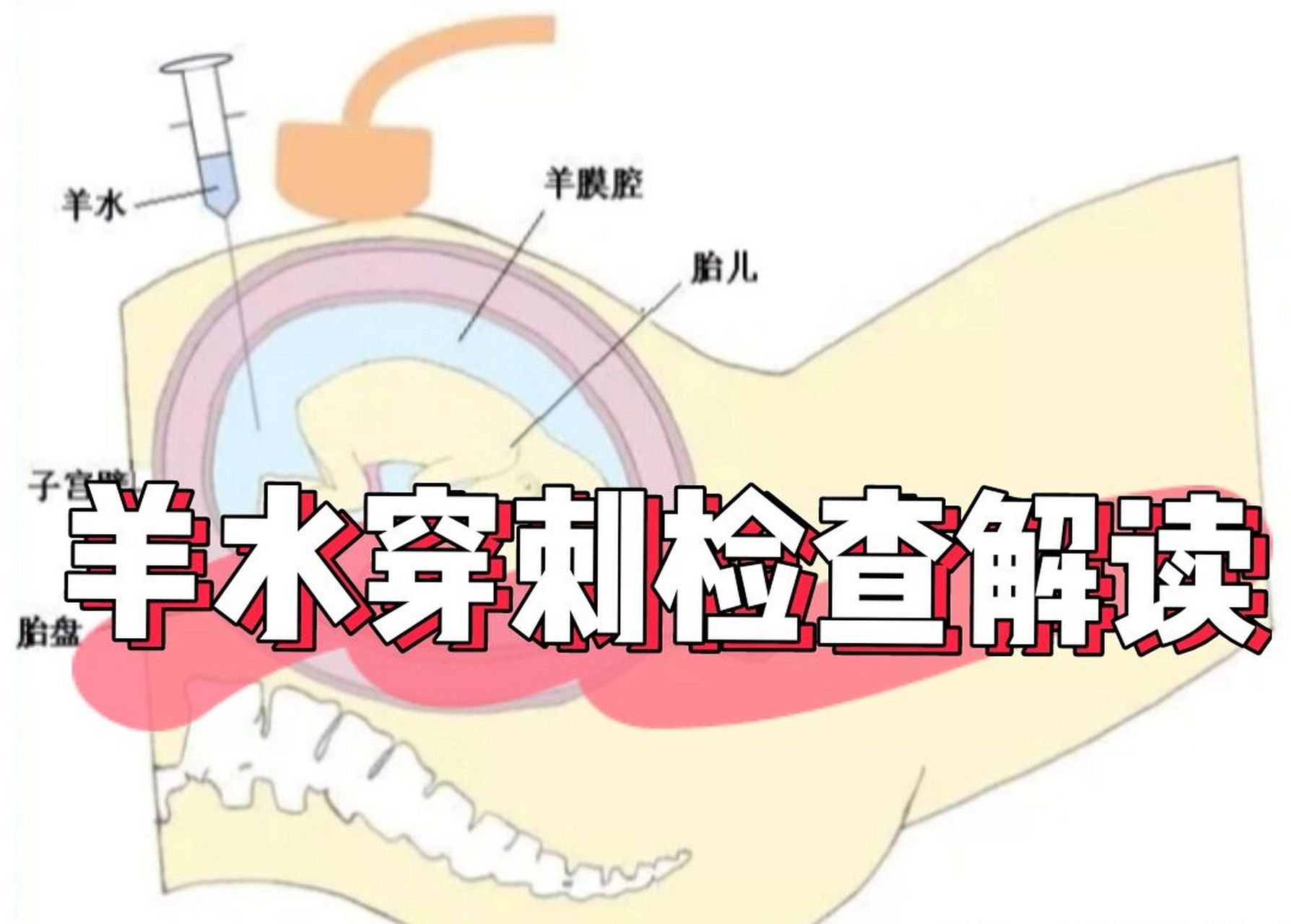 必查项目有哪 羊水穿刺检查是产前诊断的一种方法,一般适合中期妊娠的