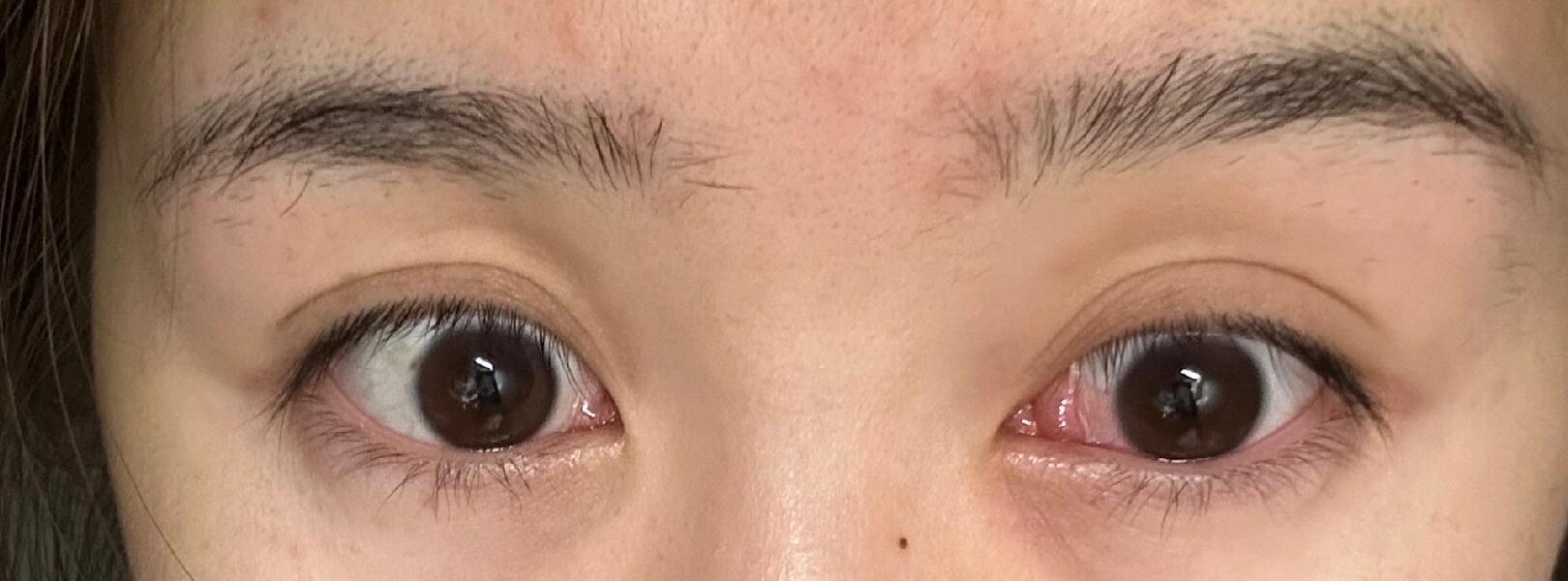 什么啊! 谁知道这是啥,泪阜又痒又肿