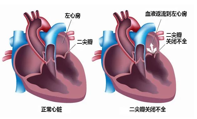 二尖瓣区位置图图片