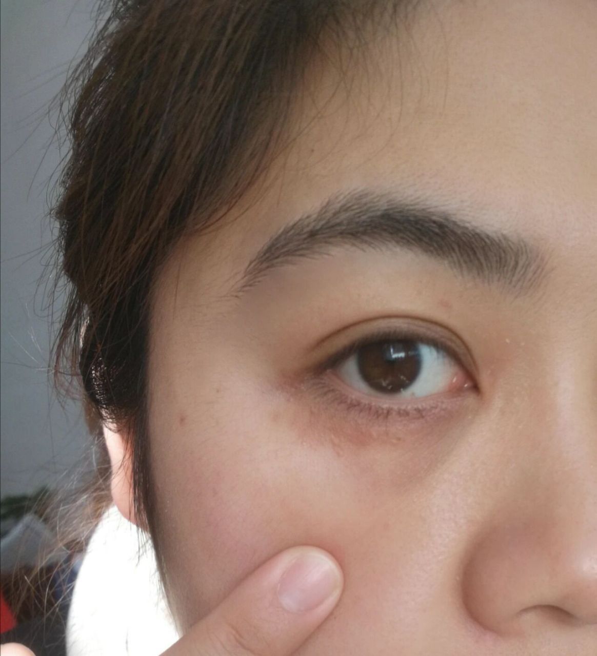汗管瘤四个月后细节图 细节图方便大家更细致的看我恢复的效果,引起的