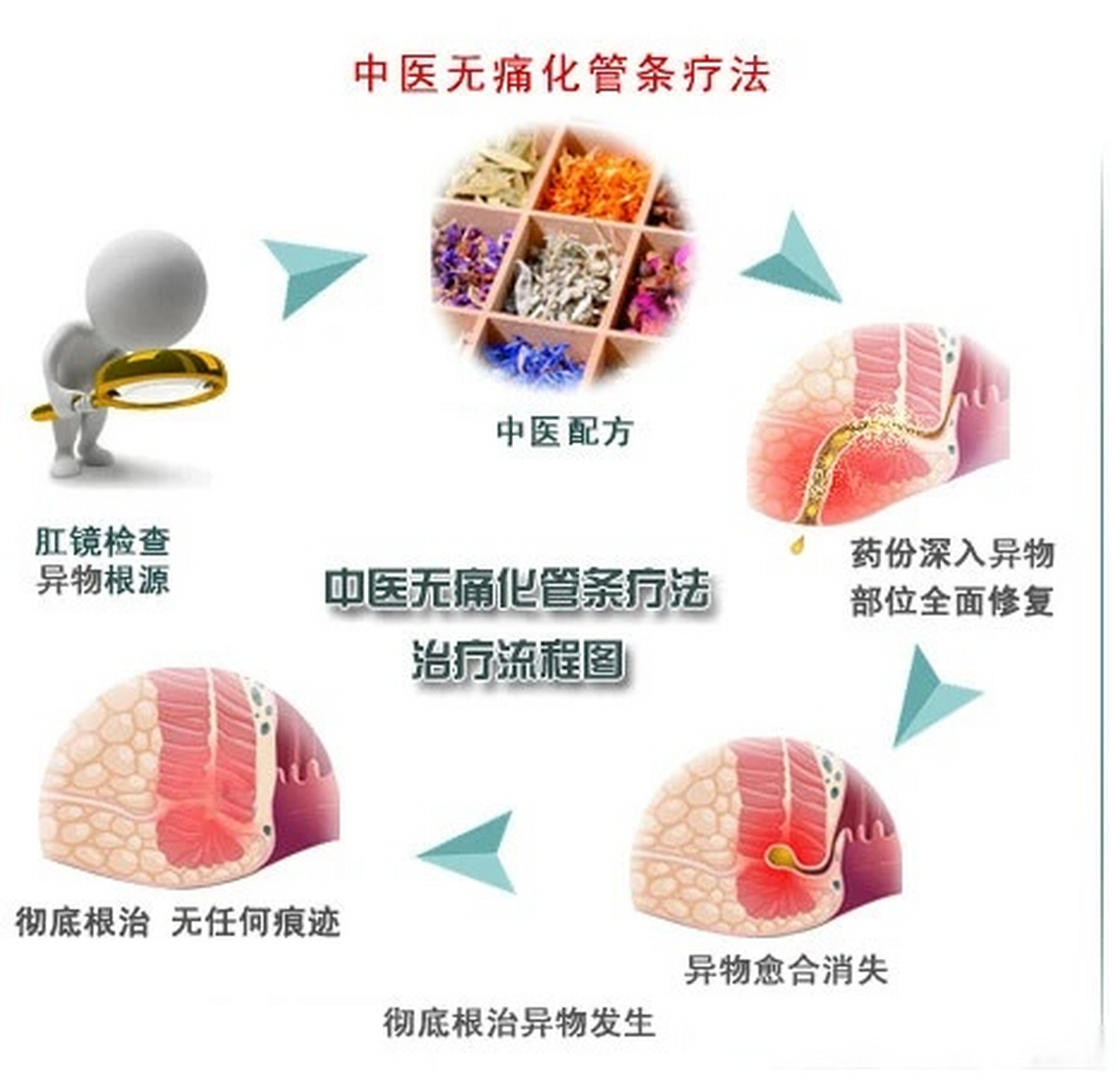 中医化管条疗法治疗肛瘘 1,肛瘘,我们可以当做崎岖蜿蜒的山路,不管它