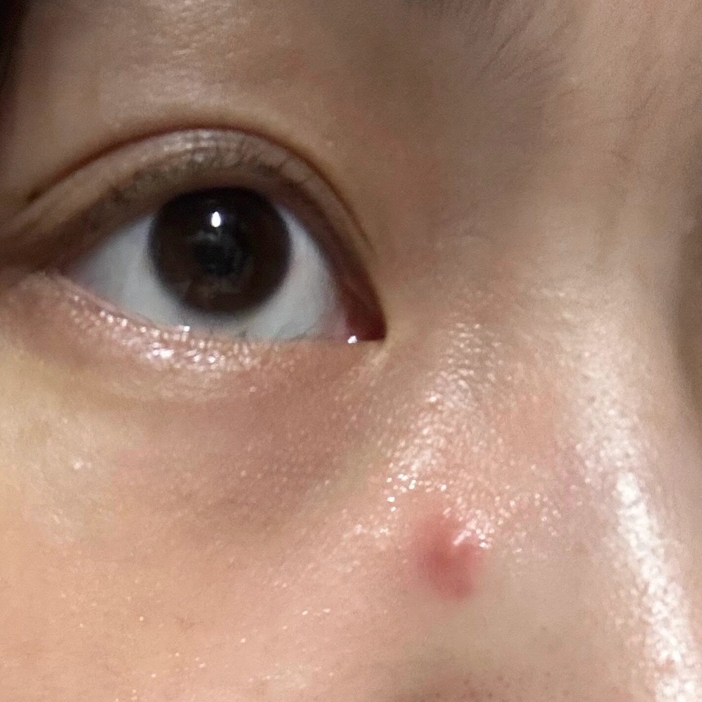 鼻子边上长了一个疙瘩 怎么办哇 存在好久了 而且变硬了 好想哭啊啊啊