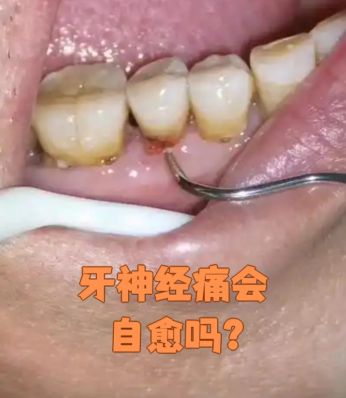 牙神经痛有可能自己好转,但要看具体是什么原因引起的