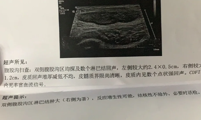 腹部右下侧有个包块可能是什么呢?