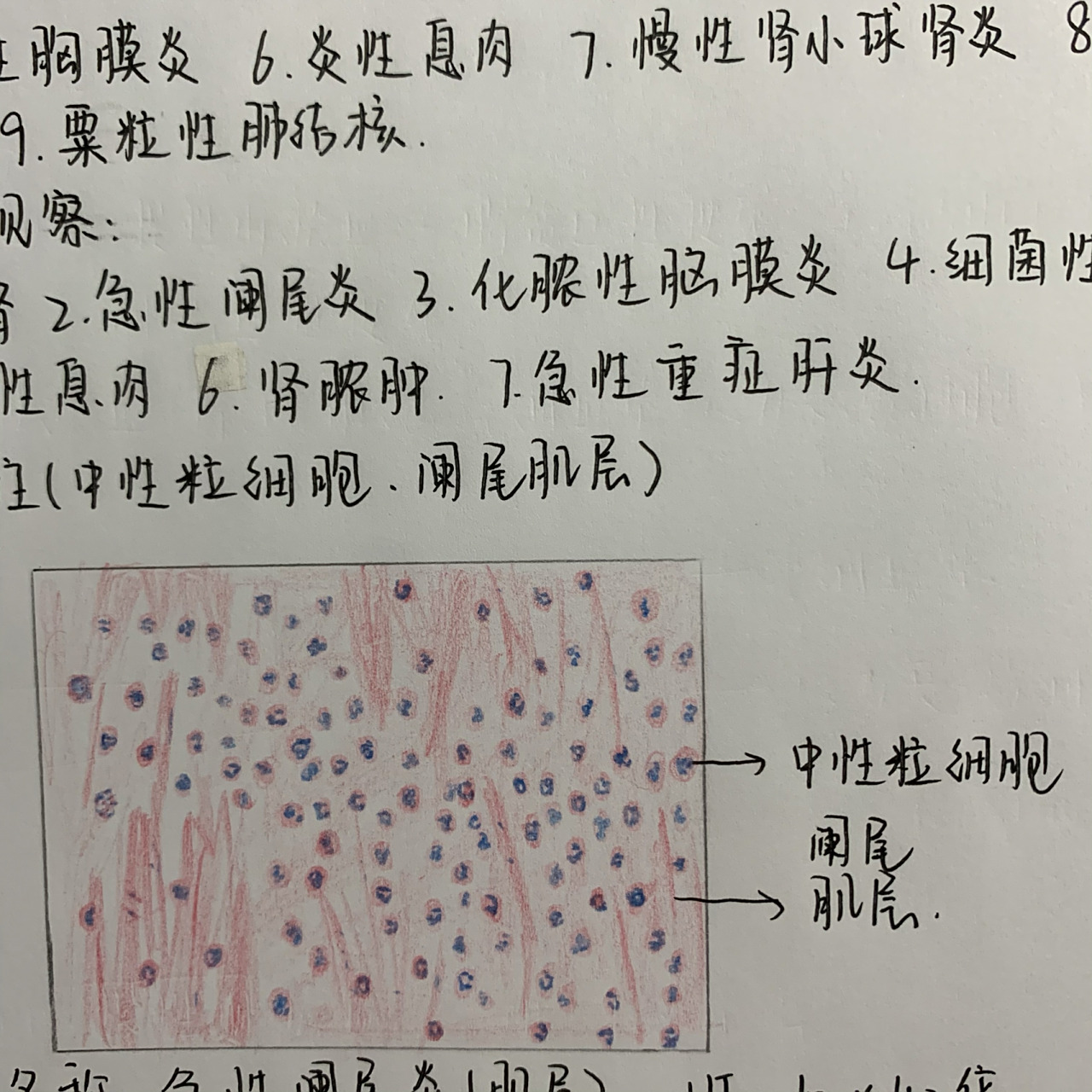 急性阑尾炎(肌层)绘图