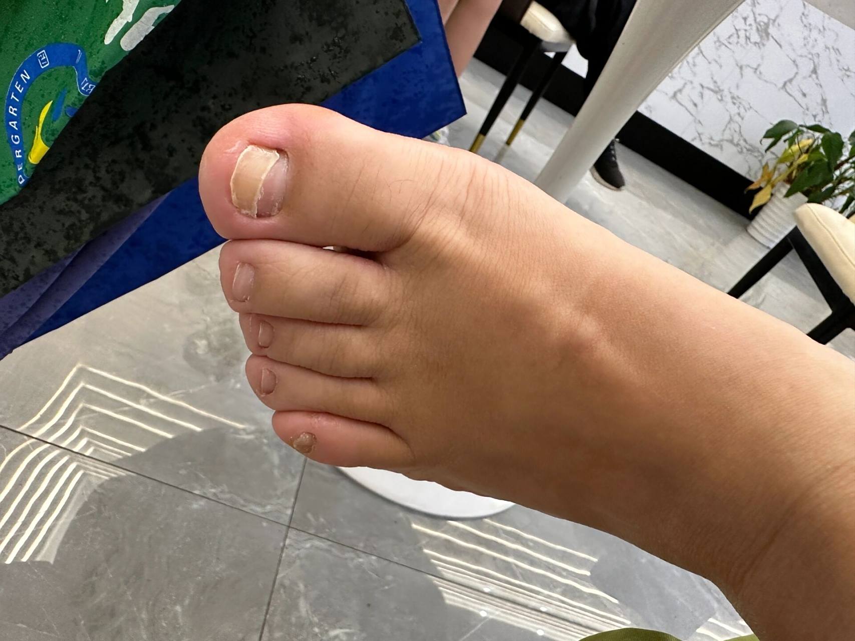 为什么大拇指指甲总是断层!新的长出来之后,还是会继续断.