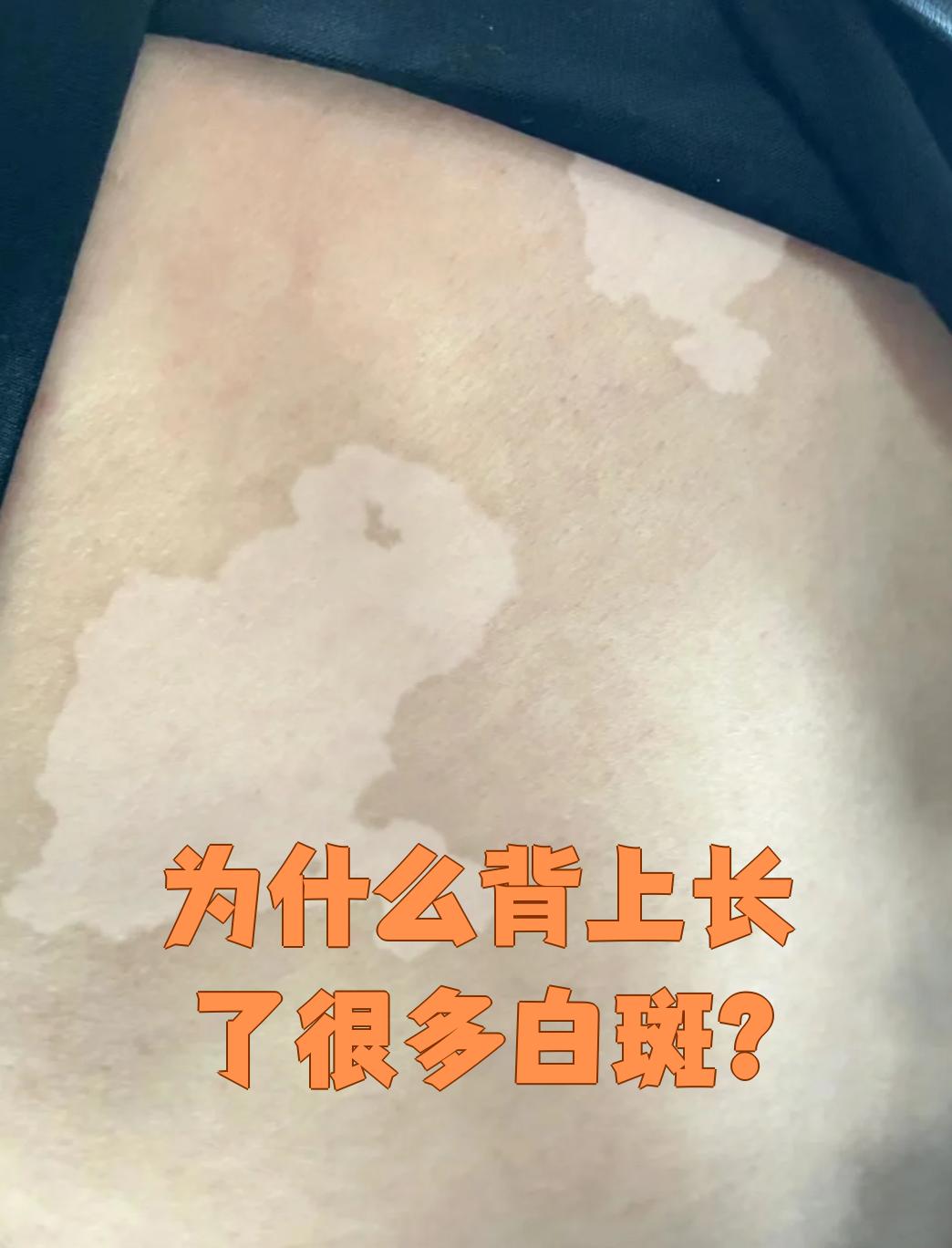 为什么背上长了很多白斑?