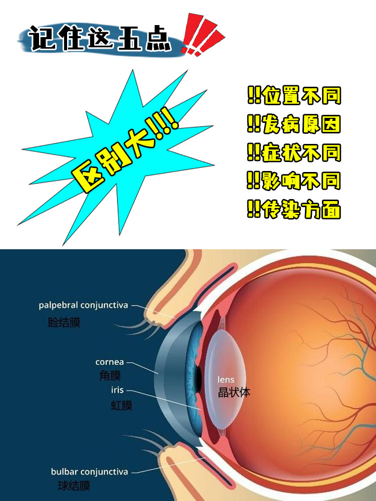 角膜炎与结膜炎的区别图片