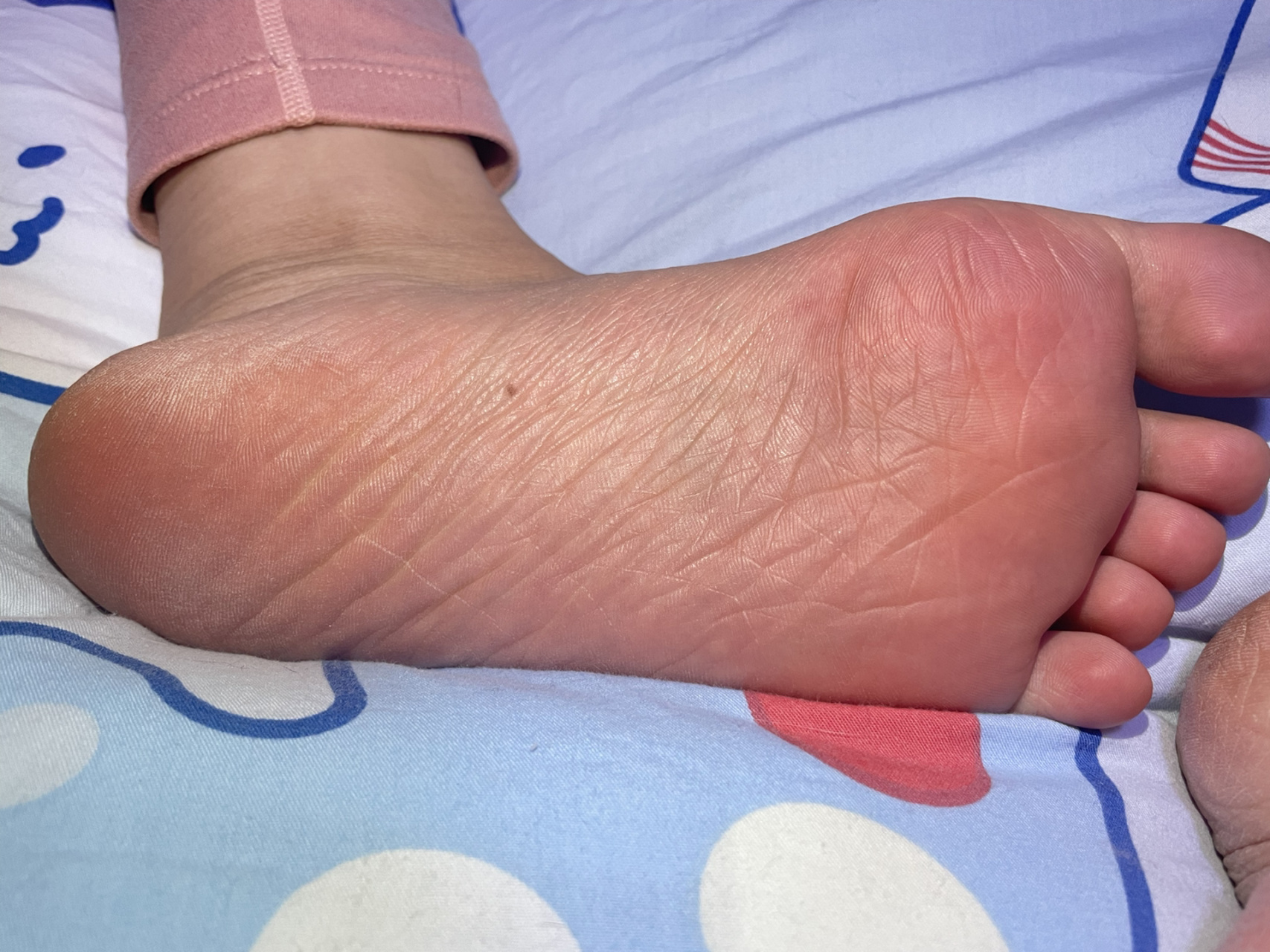 脚底痣 图一二是左脚 图三是右脚 可以一次嘎掉吗?