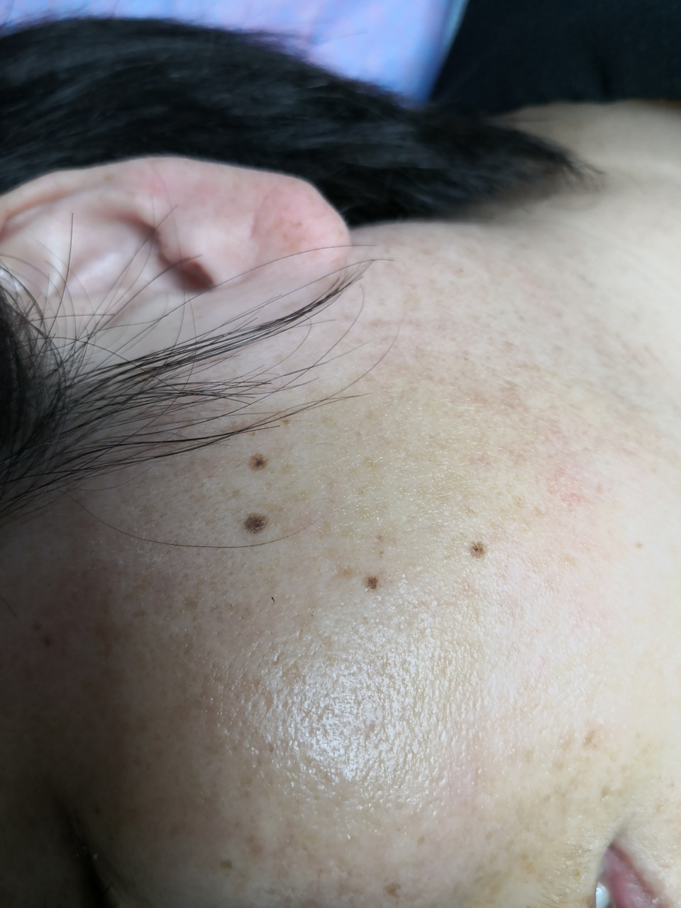 解决皮肤问题专注皮肤美容##色素痣