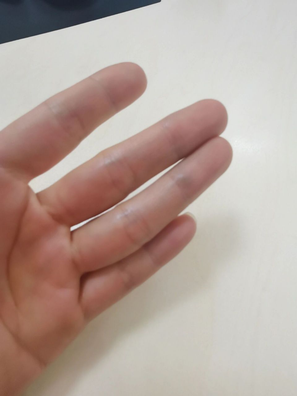 手指鼓个包 手指血管位置鼓个青色包,有谁知道是啥?