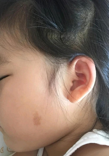 小孩子脸上长斑常见原因包括遗传,色素沉着和生活习惯问题