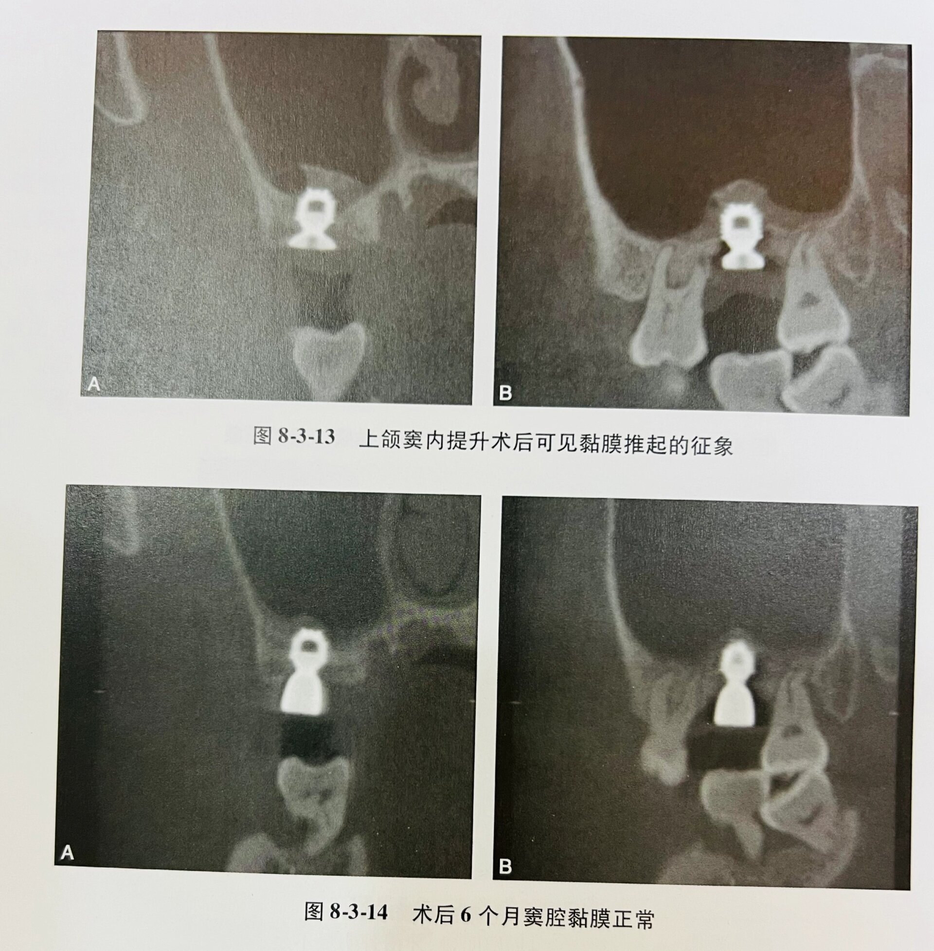 上颌腭隆突图片图片