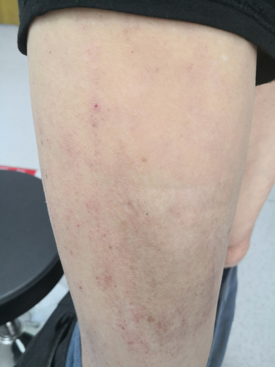 皮肤干燥瘙痒脱屑#糖尿病# 是糖尿病并发症的症状