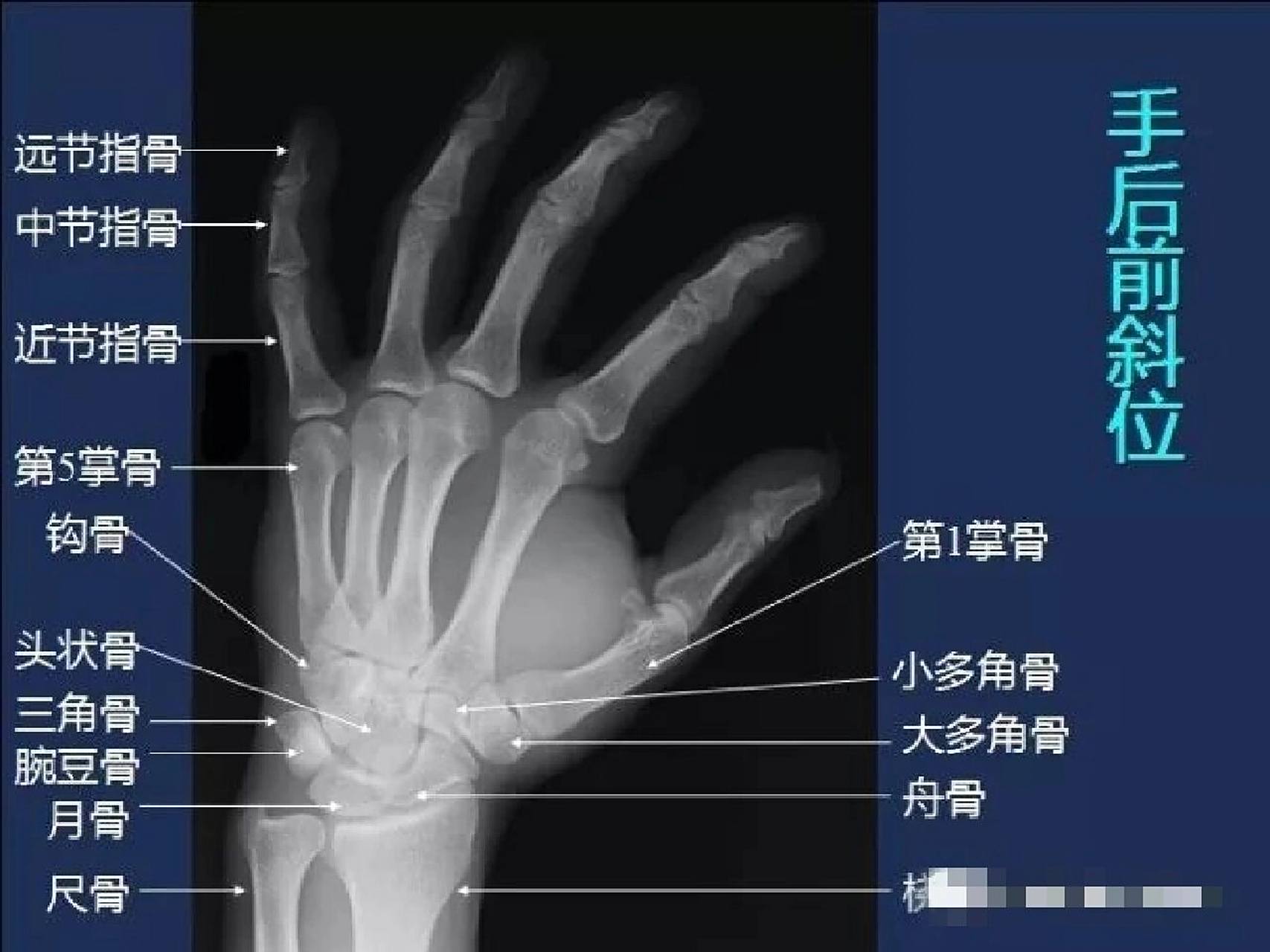 手部骨头解剖图 手掌一共27块骨头,从上到下 : 指骨14块(四个手指头各