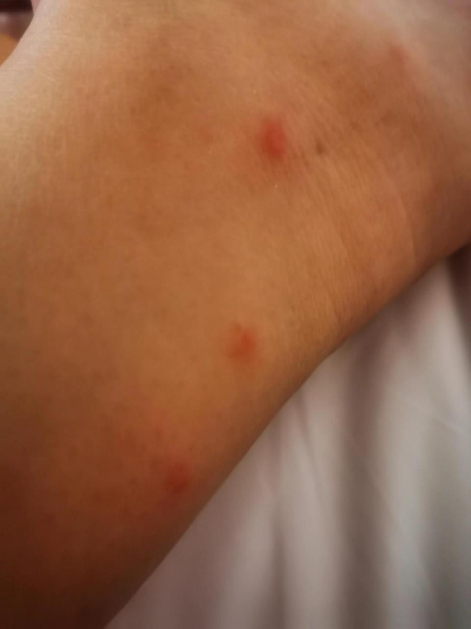 槟榔虫治疗方法 现阶段来三亚除了防控措施一定要看看下面这段话!