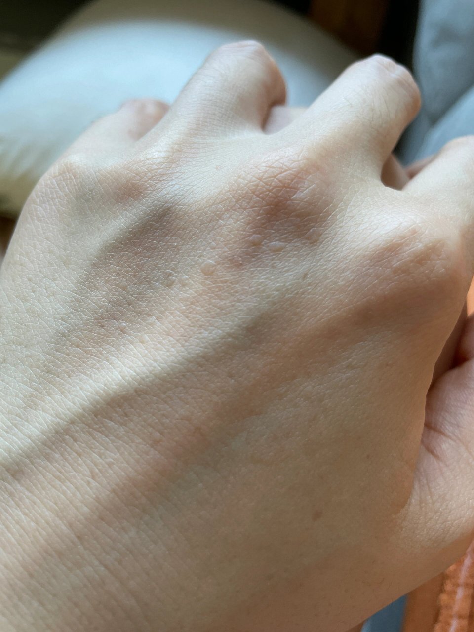 手背上长的是什么,老年斑吗?