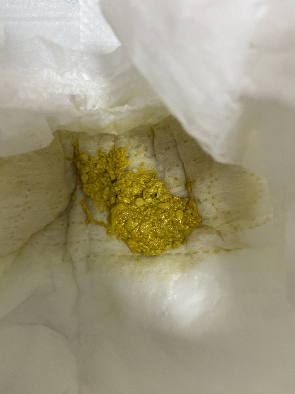 新生儿拉奶瓣儿便,水样便,求助 宝宝出生第八天,从第五天开始排便全是