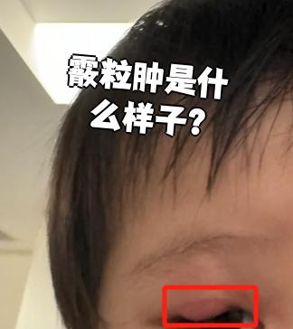 是长在眼睑皮下的小肿块,摸起来圆圆的,看起来有