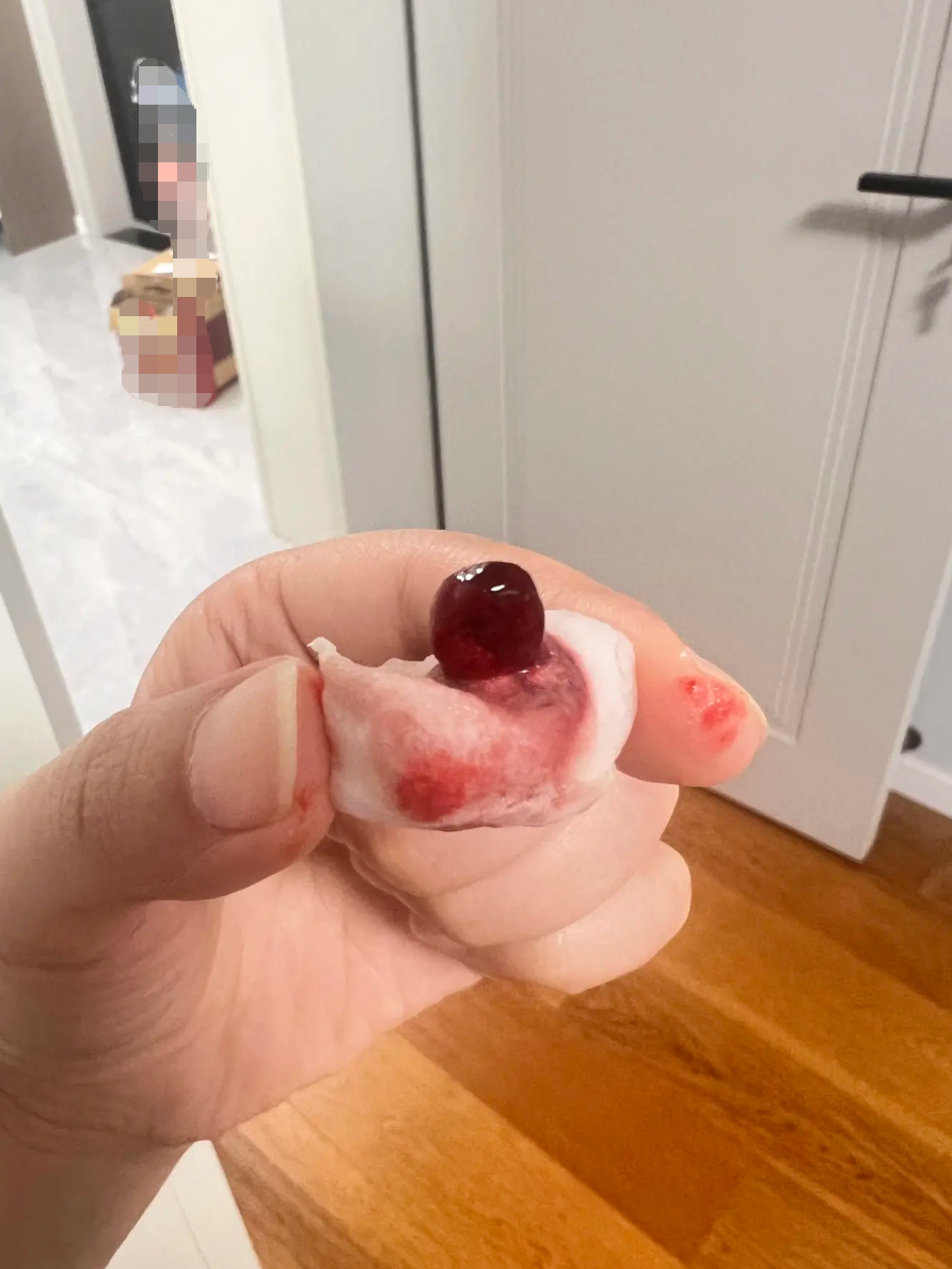 拔智齿4天后血凝块掉了?