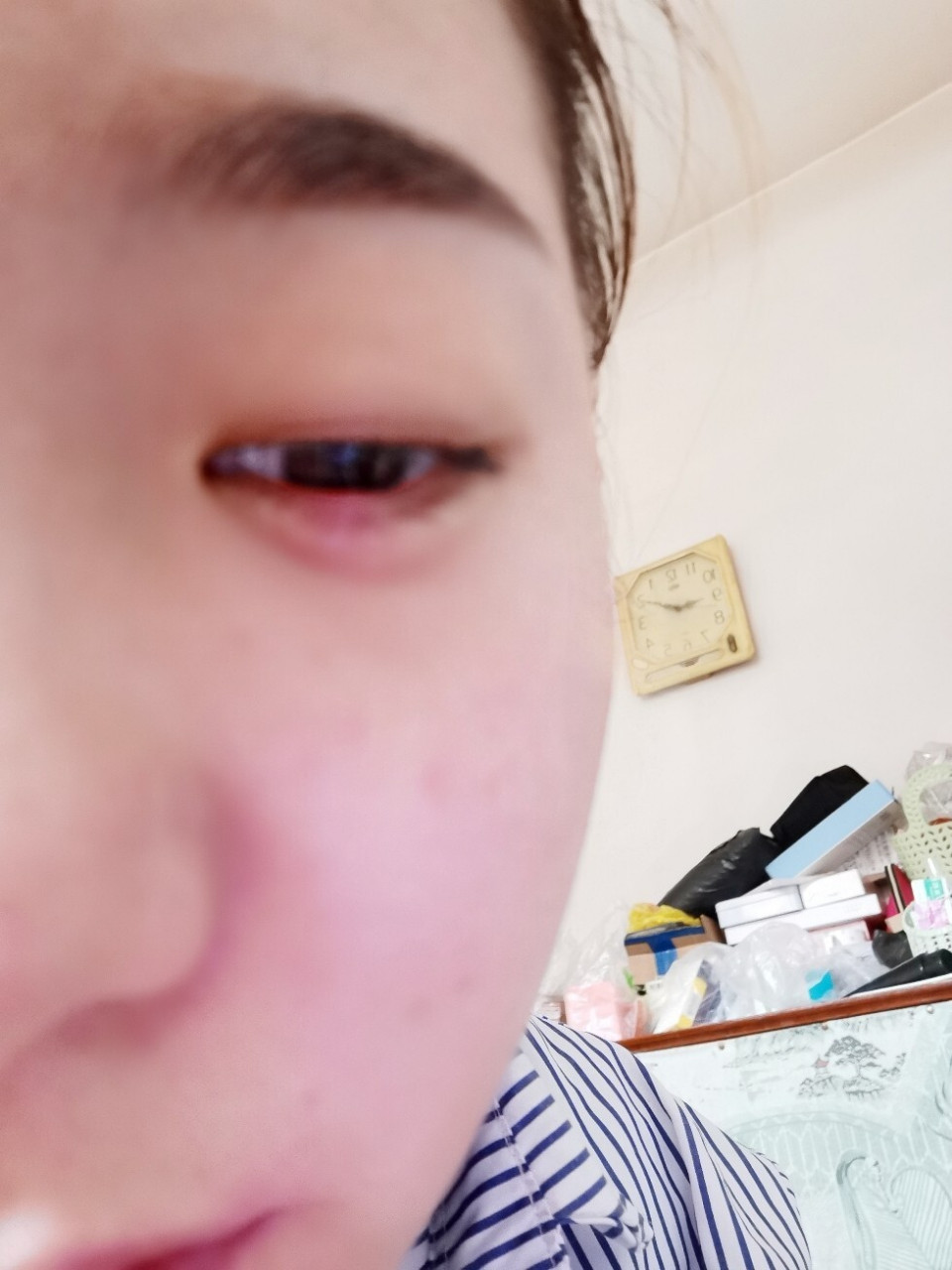 又长了眼疮 呜呜呜,火疖子才好,眼上又开始长麦粒肿,同事说是眼疮