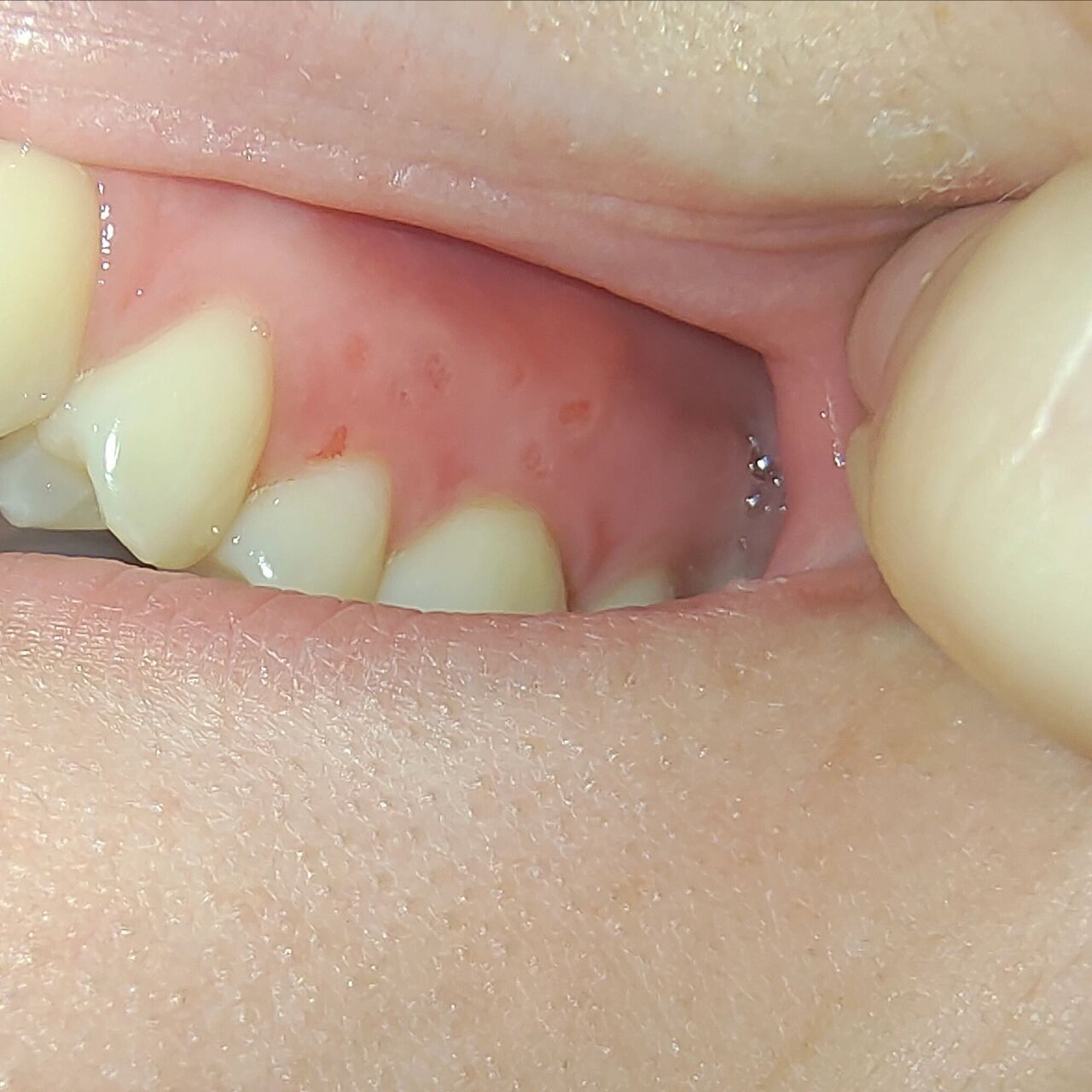 阳了之后牙龈长泡 有没有跟我一样阳了牙龈长泡然后过了一晚上泡又