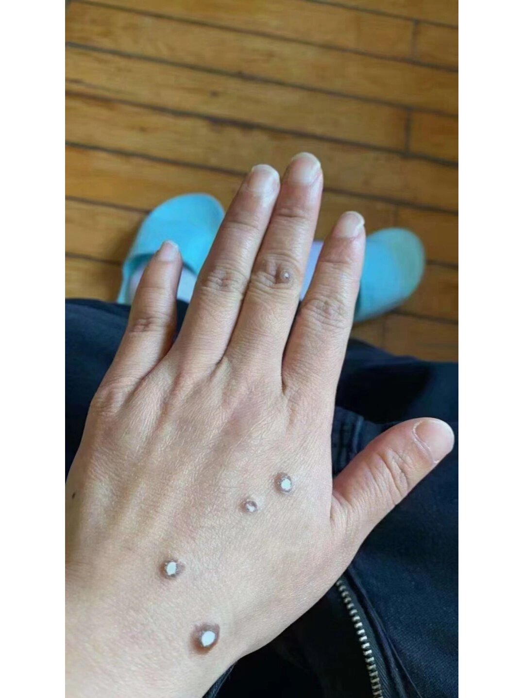 记录一下,瘊子完美脱落过程