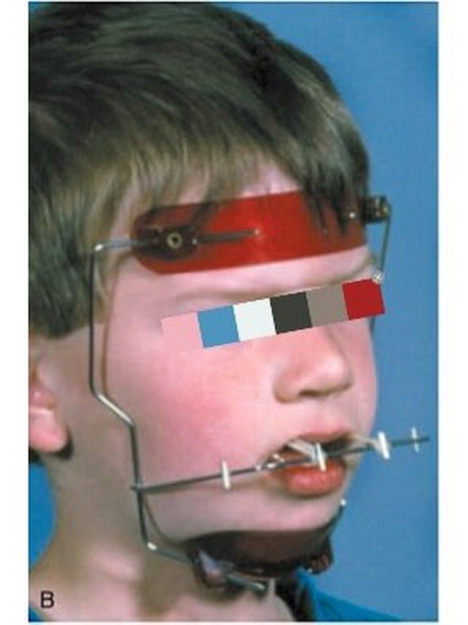 前方牵引口外部分即面具