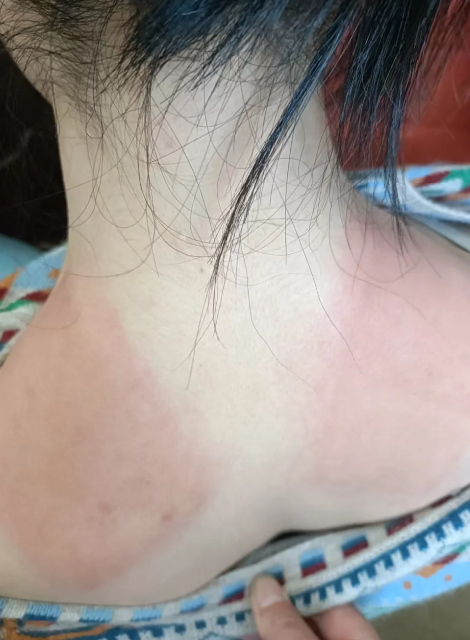 这是因为紫外线直接刺激了白斑部位的脆弱皮肤