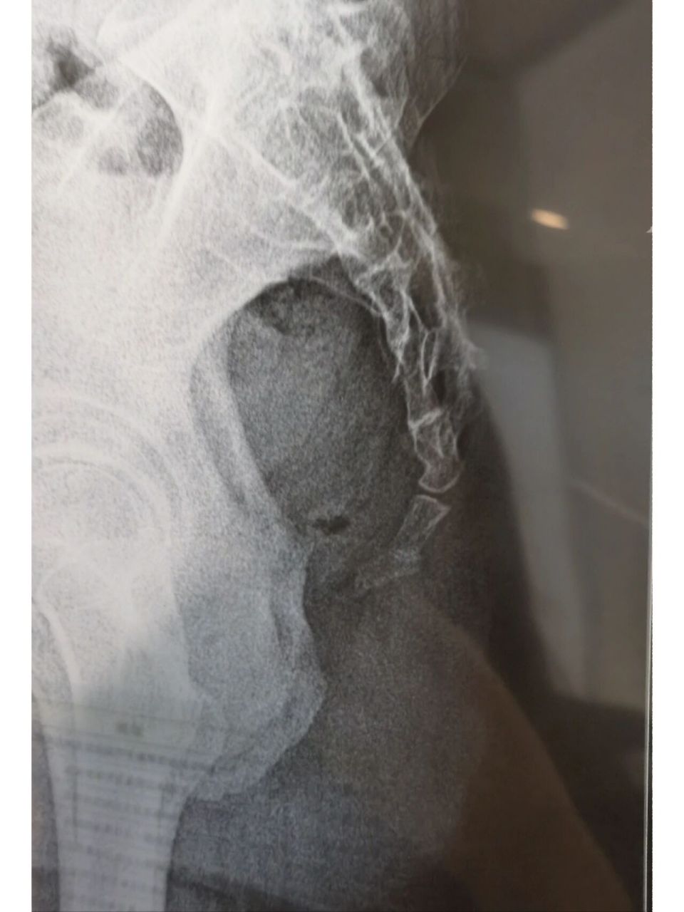 尾椎骨骨折 滑雪尾椎骨摔移位,怎么办,不滑了,收摊了