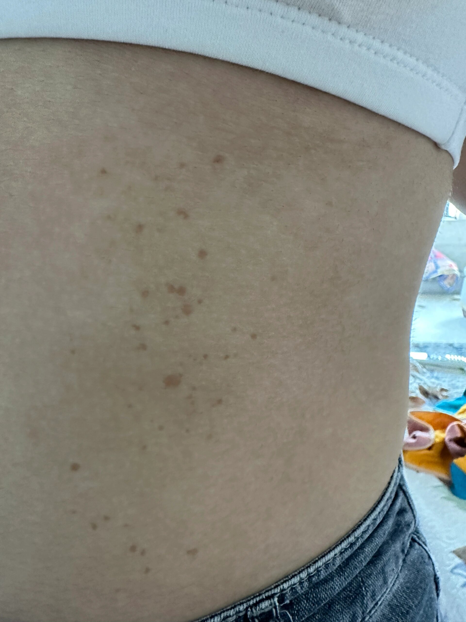 孩子身上长这样的斑点是什么?