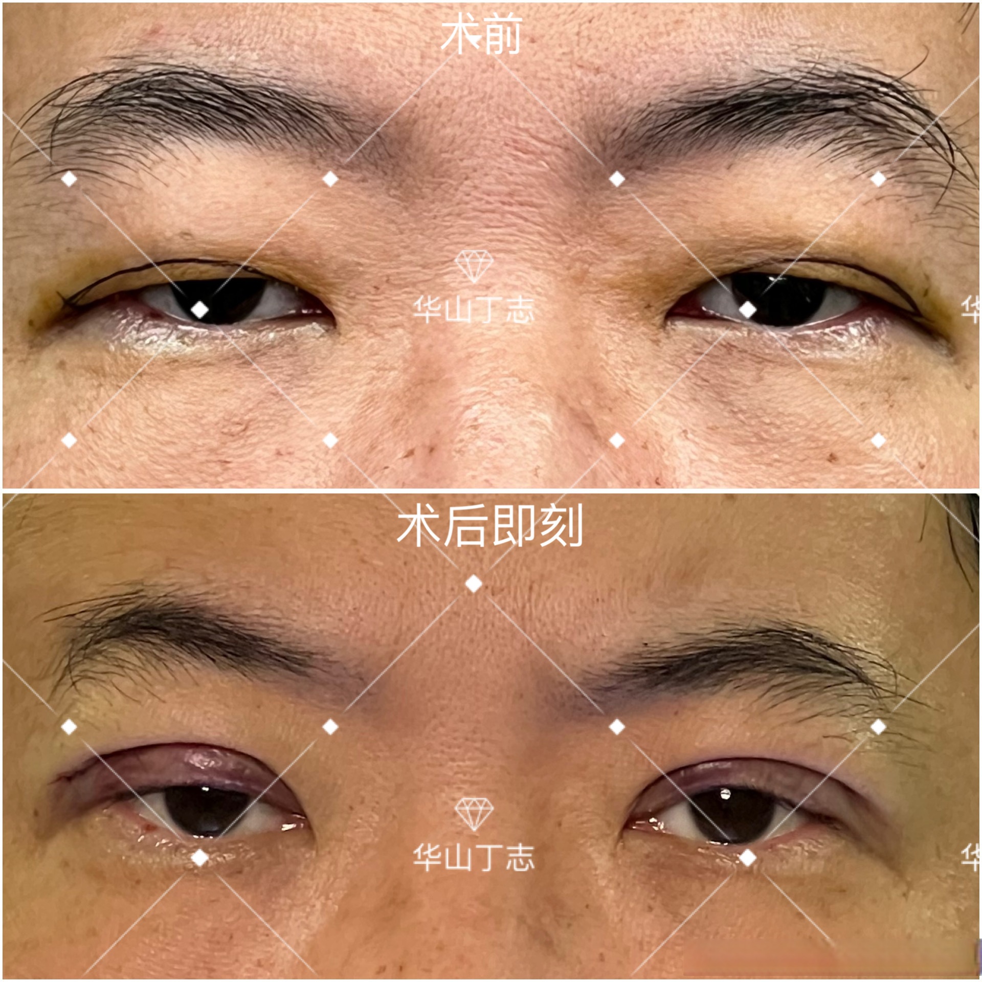 案例展示:术前严重肿泡眼,上眼睑下垂,睁眼无神,做全切双眼皮 提肌,术